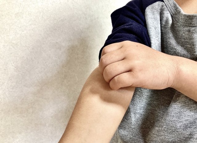 アトピー性皮膚炎